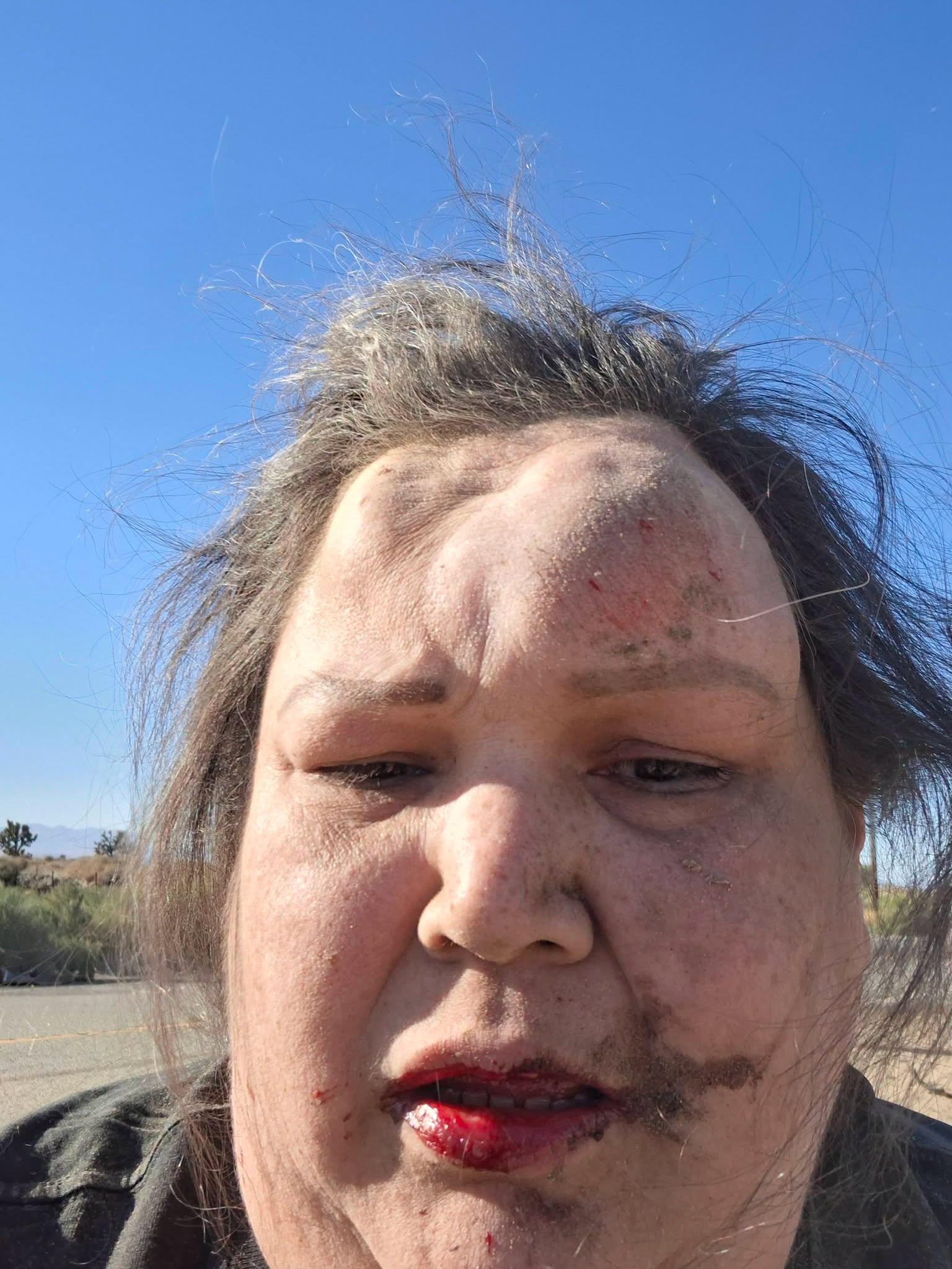 Gina with facial injuries shortly after the accident
